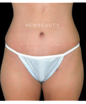 dr-tiffany-mccormack-tummy-tuck-b