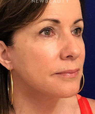 dr-dilip-madnani-facelift-co2-laser-b