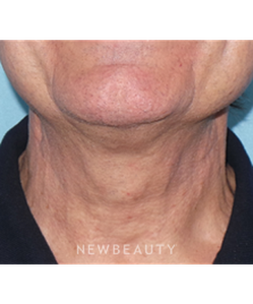 dr-sean-simon-precision-neck-lift-b