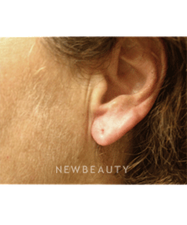 dr-kenneth-beer-injectables-fillers-b