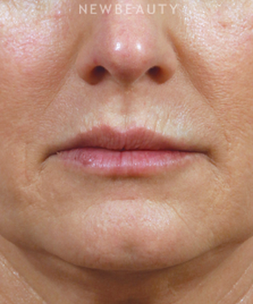 dr-kenneth-beer-lip-filler-b