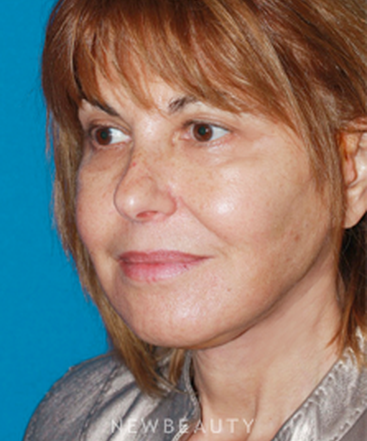 dr-konstantin-vasyukevich-traditional-facelift-b