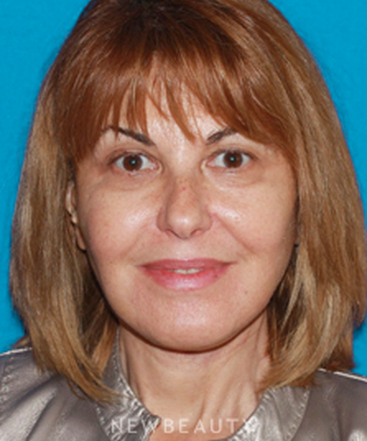 dr-konstantin-vasyukevich-traditional-facelift-b