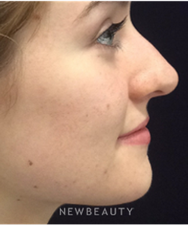 dr-kim-nichols-nonsurgical-rhinoplasty-b