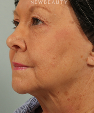dr-kenneth-beer-coolsculpting-b