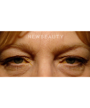 dr-baljeet-k-purewal-blepharoplasties-b
