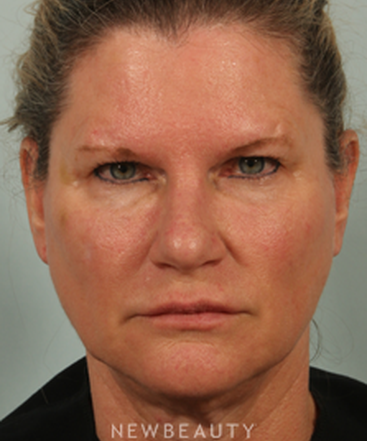 dr-kenneth-beer-liquid-facelift-b