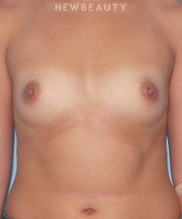 dr-sean-simon-breast-augmentation-b