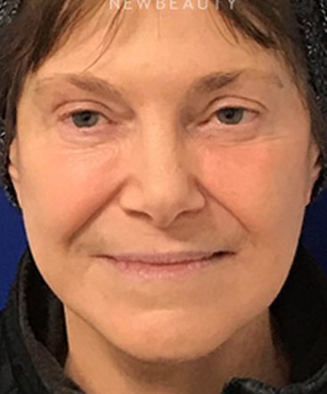 dr-dilip-madnani-facial-rejuvenation-b