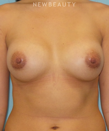 dr-sean-simon-breast-augmentation-b