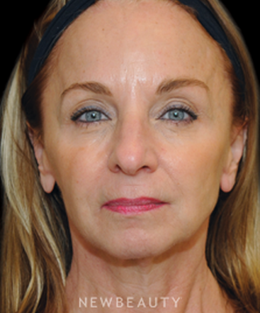 dr-janet-allenby-injectables-b