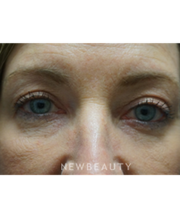 dr-niki-christopoulos-upper-blepharoplasty-b