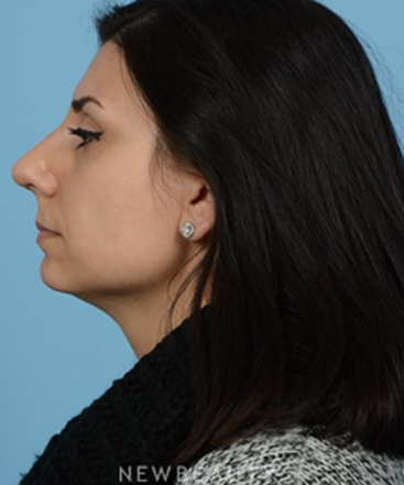dr-jeffrey-b-wise-rhinoplasty-b