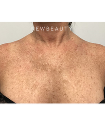 dr-marina-peredo-skinfluence-trinity-treatment-b