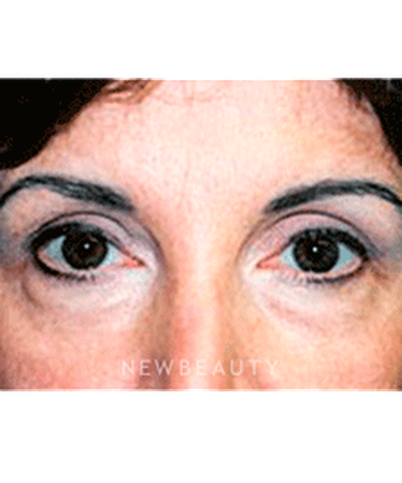 dr-sanjay-grover-blepharoplasty-b