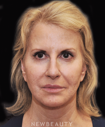 dr-janet-allenby-injectables-fillers-b