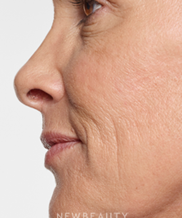 dr-marina-peredo-lip-enhancement-b