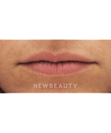 dr-kenneth-beer-lip-augmention-b