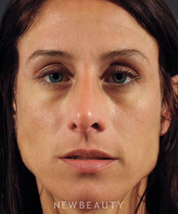 dr-marina-peredo-injectables-fillers-b