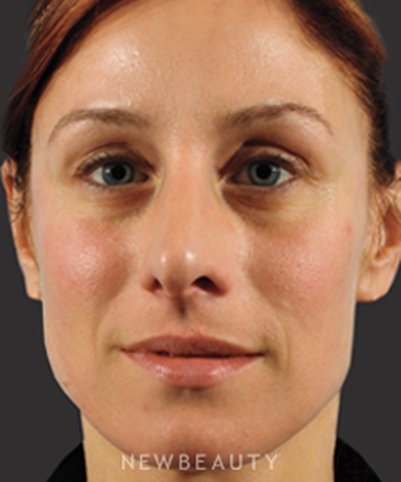 dr-marina-peredo-injectables-fillers-b