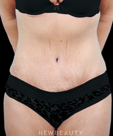 dr-bradley-bengtson-tummy-tuck-b