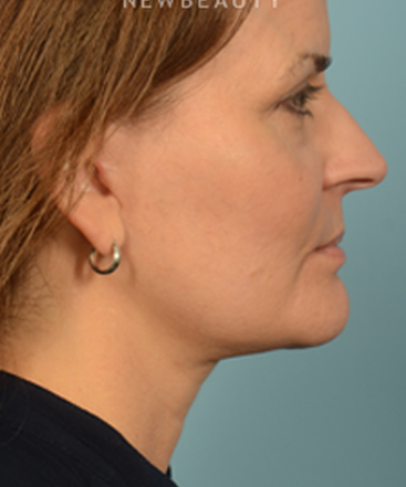 dr-bryan-gawley-facelift-b