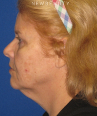 dr-dilip-d-madnani-facelift-necklift-b