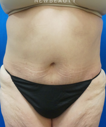 dr-niki-christopoulos-liposuction-b