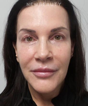 dr-marina-peredo-facelift-b