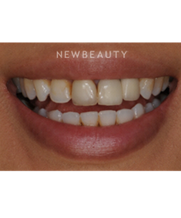 dr-ronald-goldstein-smile-makeover-b