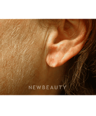 dr-kenneth-beer-injectables-fillers-b