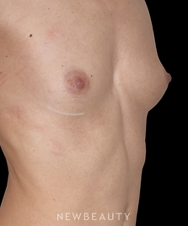 dr-david-rapaport-breast-augmentation-b