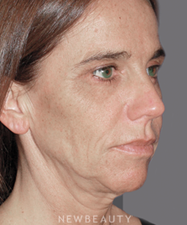 dr-konstantin-vasyukevich-facelift-necklift-b