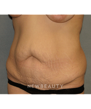 dr-sean-simon-tummy-tuck-lipo-b