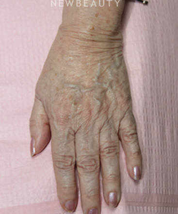 dr-jennifer-levine-lasers-b
