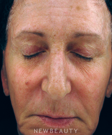 dr-kenneth-beer-ipl-laser-b