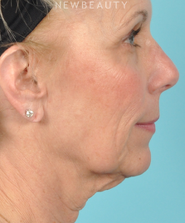 dr-bradley-bengtson-facelift-b