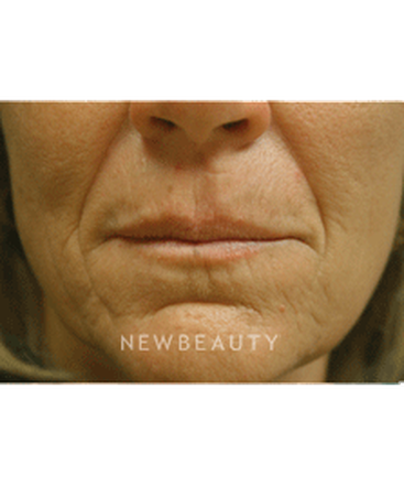 dr-kenneth-beer-injectables-fillers-b
