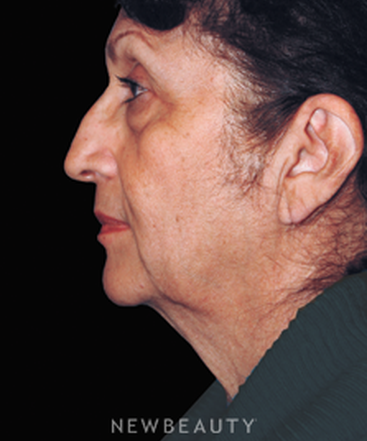 dr-brent-smith-combined-procedures-b