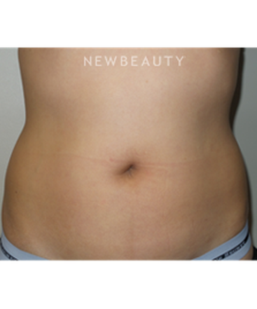 dr-sanjay-grover-coolsculpting-b