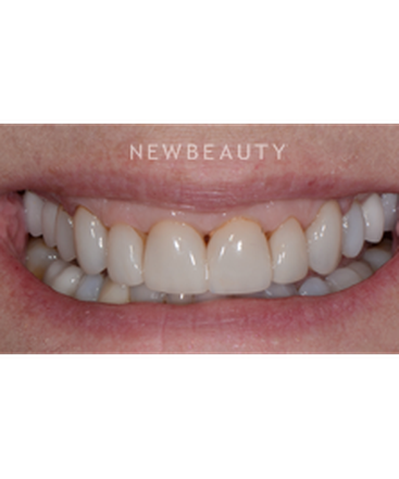 dr-guy-lewis-veneers-b