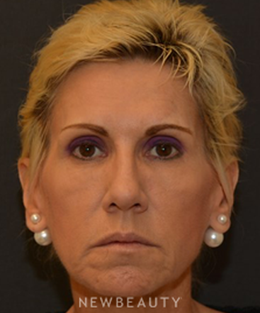 dr-janet-allenby-dysport-b