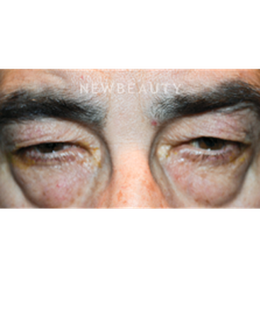 dr-baljeet-purewal-blepharoplasty-b