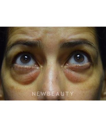 dr-jeffrey-b-wise-blepharoplasty-b