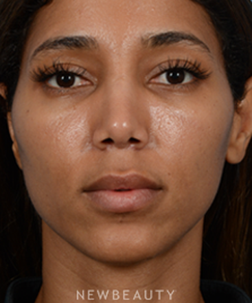 dr-jeffrey-b-wise-nasal-tip-refinement-b