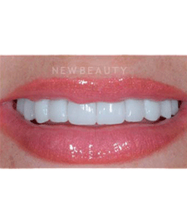 dr-guy-lewis-veneers-b
