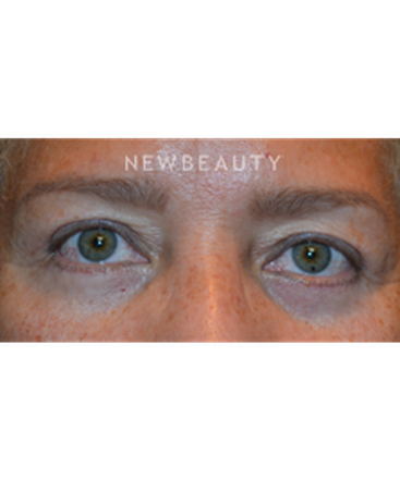 dr-baljeet-k-purewal-blepharoplasties-b
