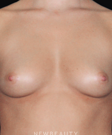 dr-joseph-grzeskiewicz-breast-augmentation-b