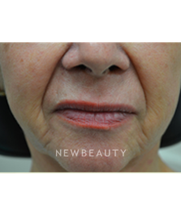 dr-baljeet-purewal-liquid-facelift-b