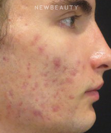 dr-kim-nichols-acne-treatment-b